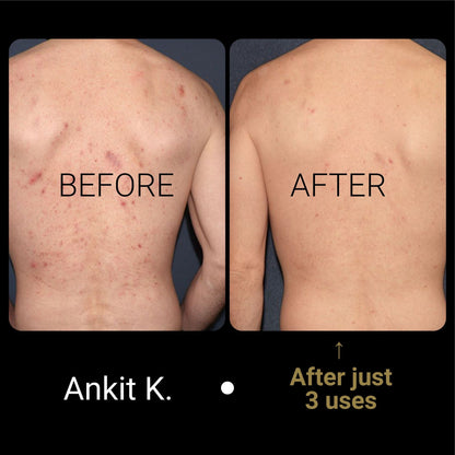 ACNE Body Wash for Men