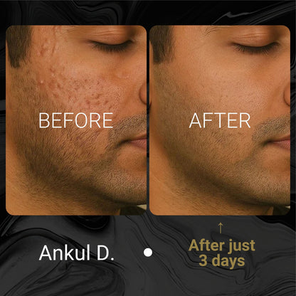 ACNE Face Wash for Men